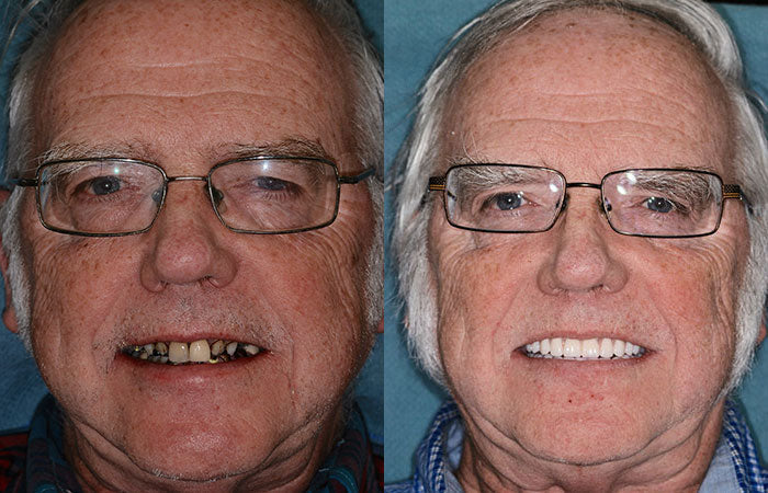 HidoneĀ® Full Denture Setš¦·š¦·šAdvanced Self-Adjusting Dental Materials (ā°Limited time discount last 30 minutesā°)