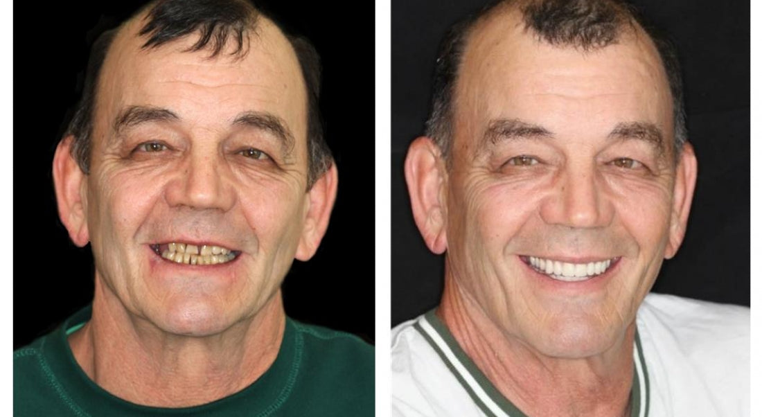 HidoneĀ® Full Denture Setš¦·š¦·šAdvanced Self-Adjusting Dental Materials (ā°Limited time discount last 30 minutesā°)