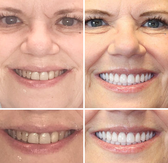HidoneĀ® Full Denture Setš¦·š¦·šAdvanced Self-Adjusting Dental Materials (ā°Limited time discount last 30 minutesā°)