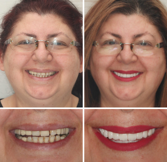 HidoneĀ® Full Denture Setš¦·š¦·šAdvanced Self-Adjusting Dental Materials (ā°Limited time discount last 30 minutesā°)