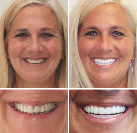 HidoneĀ® Full Denture Setš¦·š¦·šAdvanced Self-Adjusting Dental Materials (ā°Limited time discount last 30 minutesā°)