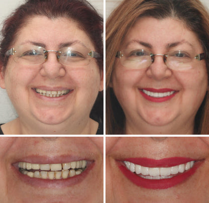 Hidone® Full Denture Set🦷🦷💃Advanced Self-Adjusting Dental Materials (⏰Limited time discount last 30 minutes⏰)
