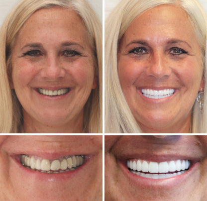 Hidone® Full Denture Set🦷🦷💃Advanced Self-Adjusting Dental Materials (⏰Limited time discount last 30 minutes⏰)
